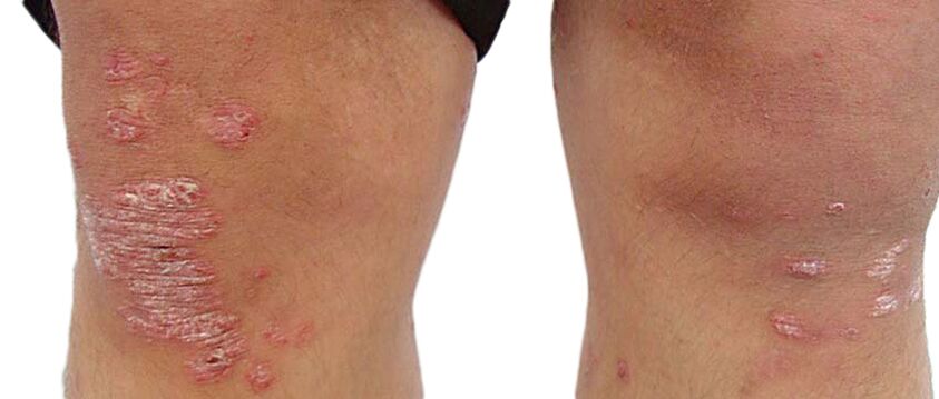 Psoriasis is an unpleasant skin disease that needs to be treated with Keraderm cream