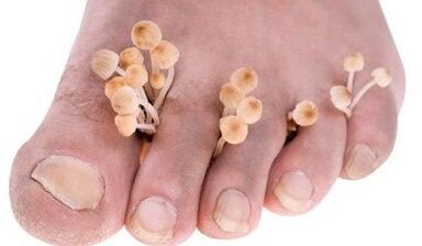 Causes of fungi development between toes