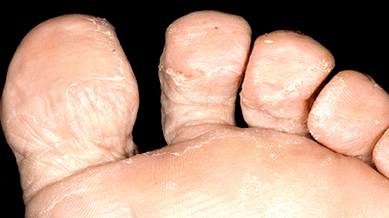 How to identify the presence of fungi between toes