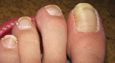 How fungi on nails manifest