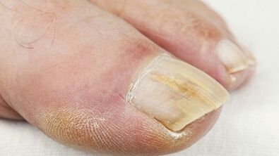 The initial stages of fungus development on nails