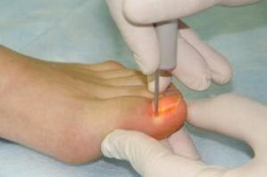 Mechanical nail removal to treat fungal infections