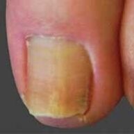 Yeast lesions of nails
