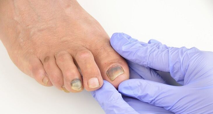Check toenails for fungus