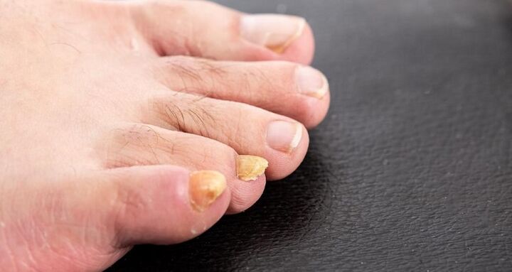 Foot fungus causes nails to turn yellow