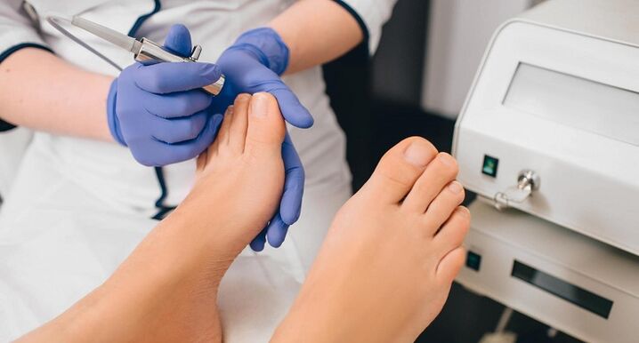 Professional treatment for onychomycosis