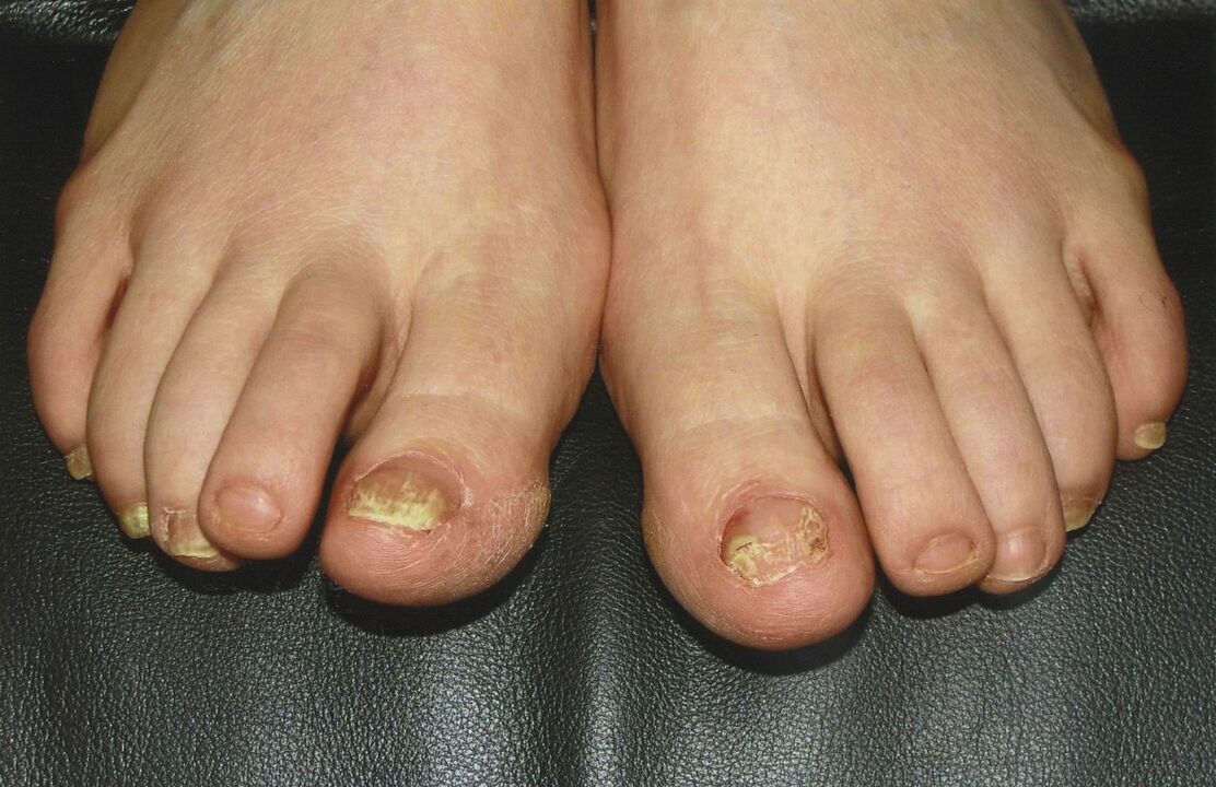 How to treat onychomycosis with nail polish