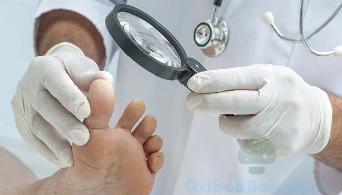 Doctor diagnoses foot fungus