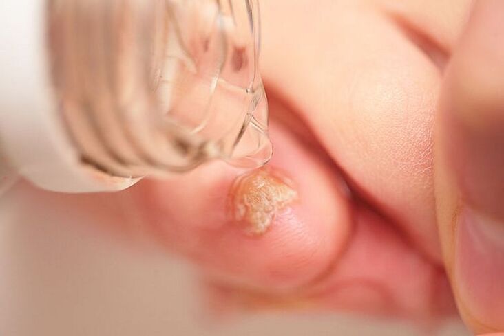 How does hydrogen peroxide work on fungi