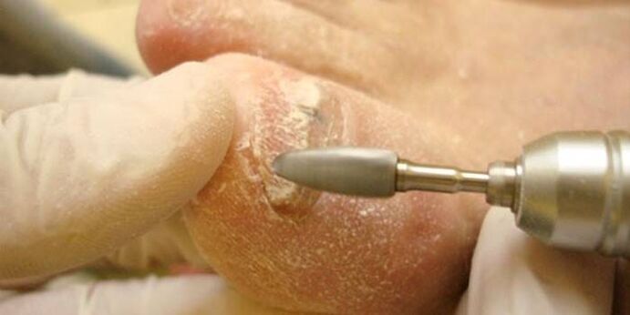 fungus nail removal