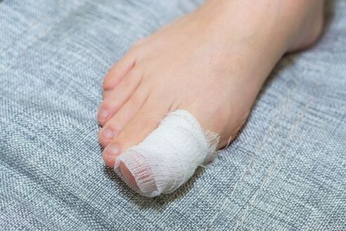 Apple cider vinegar lotion to treat onychomycosis
