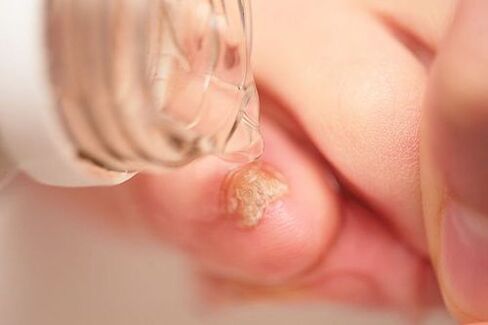 Apple cider vinegar treats onychomycosis