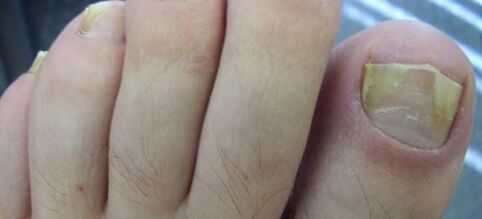 Fungal symptoms on nails and their treatment with vinegar