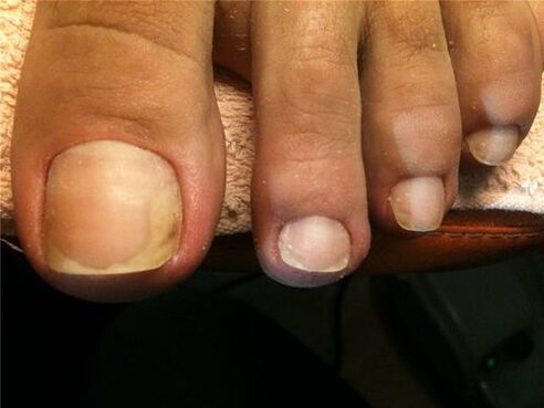 deck fungal infection