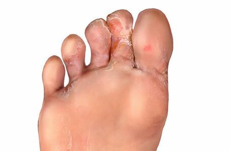 Symptoms of fungus between toes