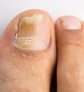 Nail fungus on the big toe, which occurs on a background of weakened immunity