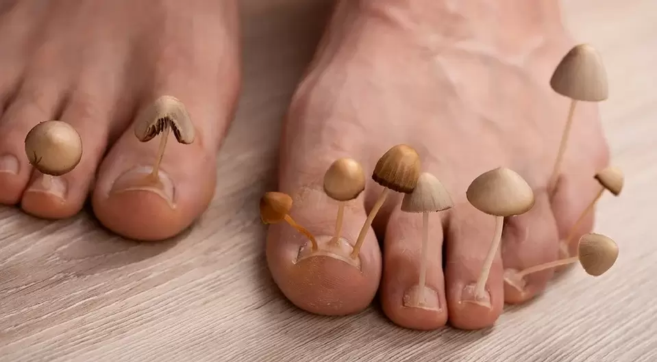 Fungal infections affecting toenails