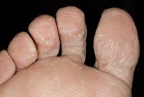 Fungal infection on the skin of feet