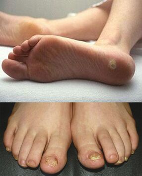 Manifestations of foot skin and nail mycoses