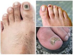 Signs of Fungal Toenail Infection