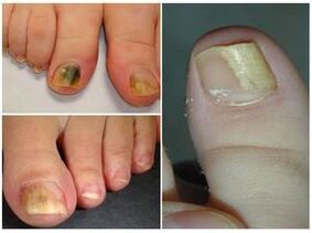 The appearance of toenails with onychomycosis