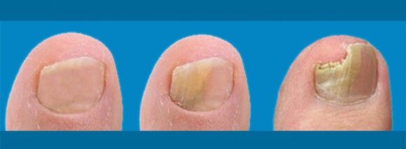 Onychomycosis – the development of toenail fungus
