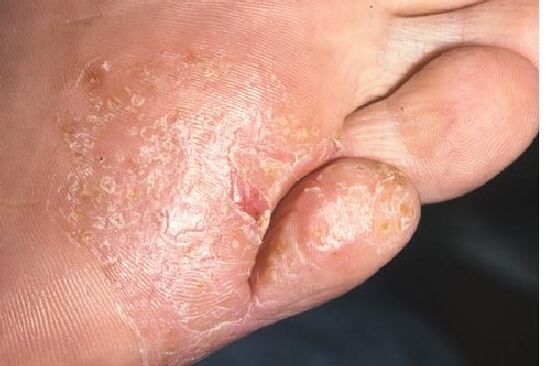 Symptoms of foot skin fungal infection
