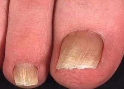 Nail fungi on the legs in the initial stage